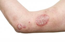 psoriasis on arm