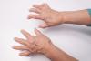 hands with rheumatoid arthritis